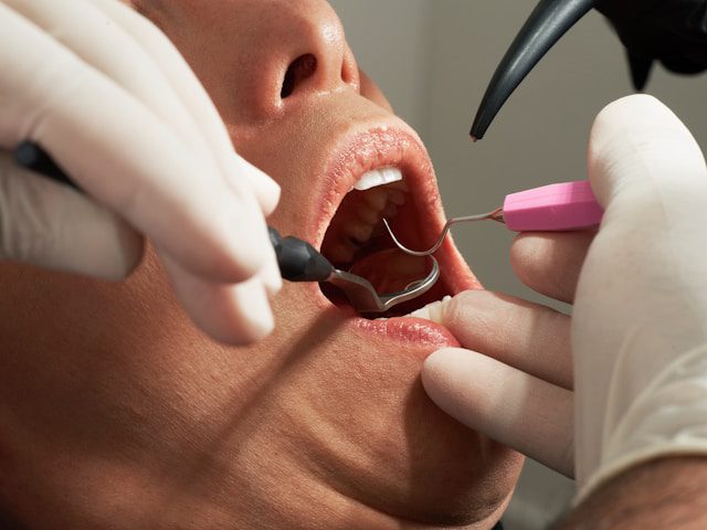 Recovery After Root Canal