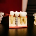 Common Myths About Dental Implants